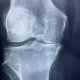 كيفية تحسين نوعية الحياة لمرضى التهاب المفاصل